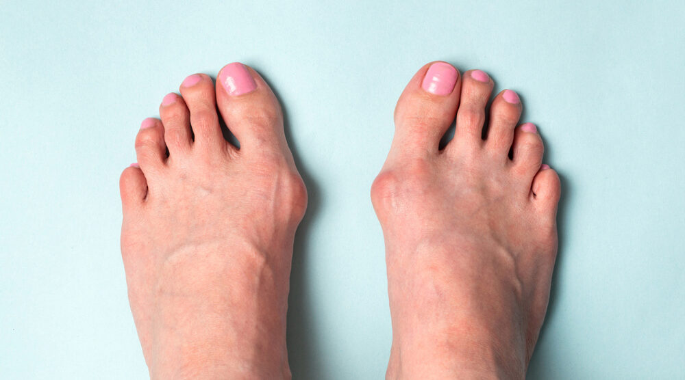 Symptômes de l’Hallux Valgus