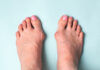 Symptômes de l’Hallux Valgus