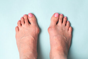Symptômes de l’Hallux Valgus