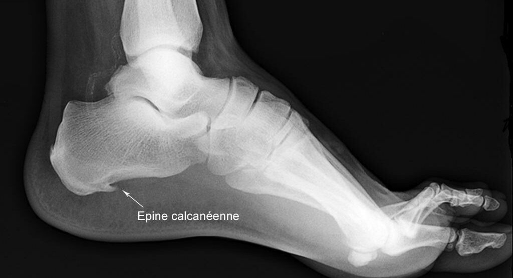 Épine calcanéenne : une cause fréquente de douleur au talon