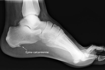 Épine calcanéenne : une cause fréquente de douleur au talon
